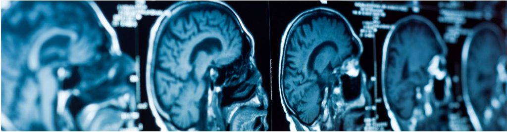 Untitled design (6) traumatic brain injury